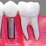 Implant dentar Megagen VelvetDental