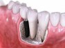 Realizare implanturi dentare DentalCrownHealth.ro